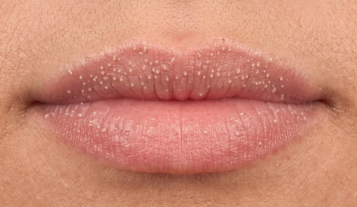 Labios con puntos de Fordyce visibles