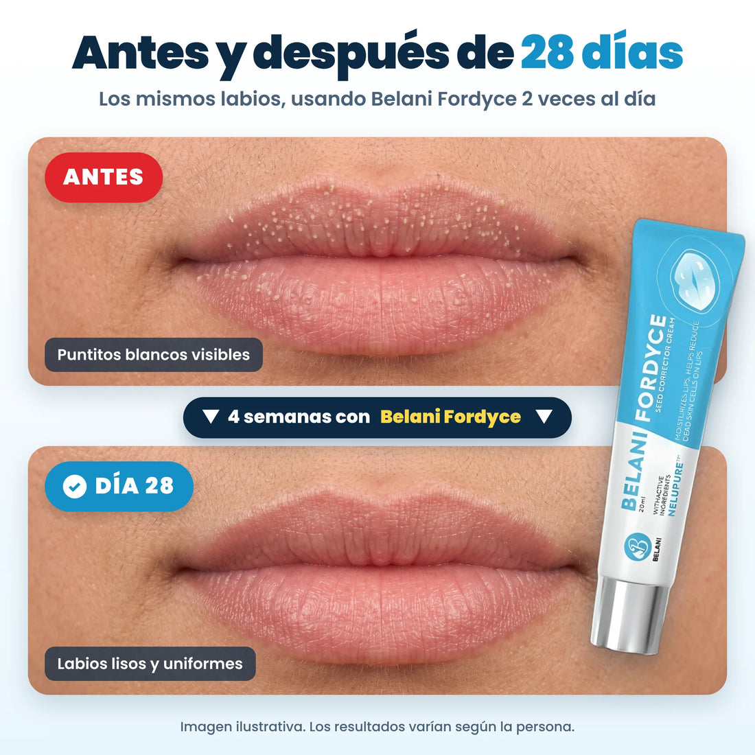 Antes y después de 28 días usando Belani Fordyce (imagen ilustrativa)